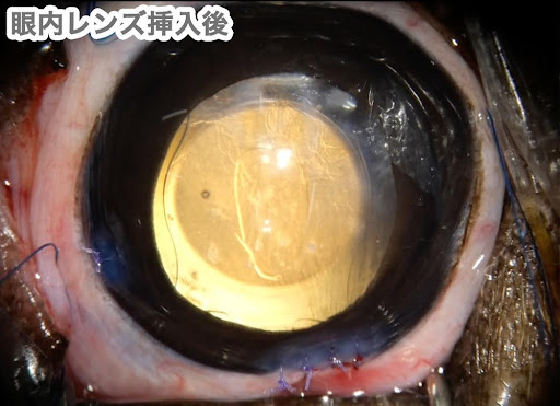 眼内レンズ挿入後